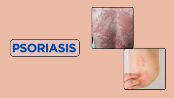 Psoriasis Management